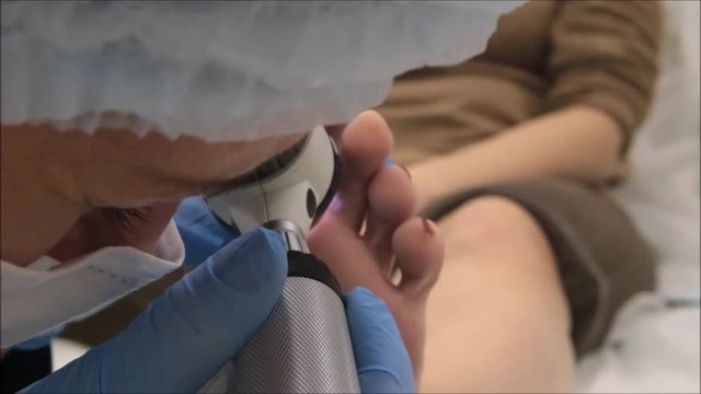 Dermatologist surgeon performs medical examination using dermatoscope before procedure to remove plantar wart