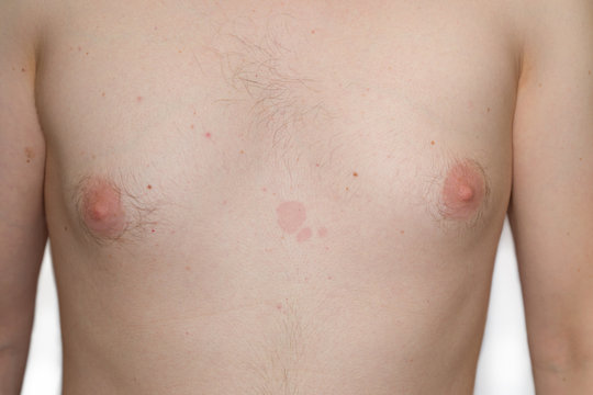 Brust eines jungen Mannes mit Hautpilz