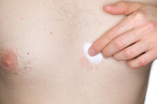 Brust eines jungen Mannes mit Hautpilz
