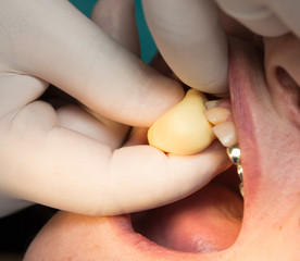 doctor makes a plastic prosthetic dentistry