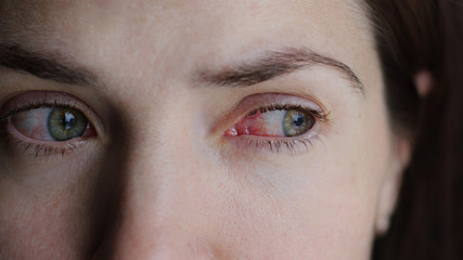 Obraz premium Zbliżenie podrażnionych lub zakażonych czerwonych przekrwionych oczu - zapalenie spojówek