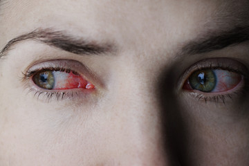 Obraz premium Zbliżenie na podrażnione lub zakażone czerwone przekrwione oczy - zapalenie spojówek