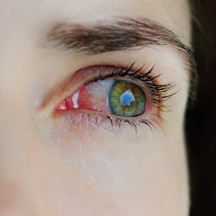 Closeup of irritated or infected red bloodshot eyes - conjunctivitis