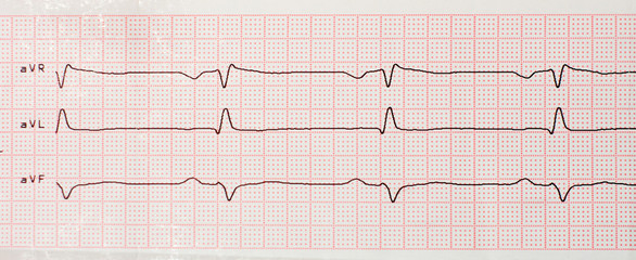 Results of cardiogram on sheet of paper