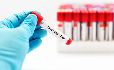 Blood sample for uric acid test, gouty arthritis diagnosis