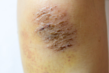 Closed up of red scab injury on woman knee background