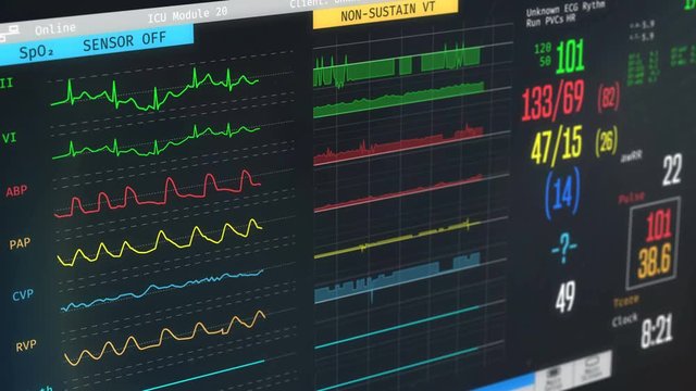 ICU monitor showing patient's condition, high temperature, arrhythmia, illness. Medical ICU monitor with patient's vital signs