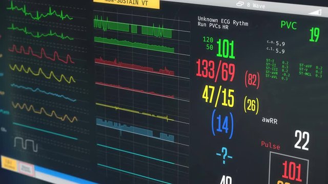 ICU medical monitor, patient's condition getting worse, irregular heartbeat. Medical ICU monitor with patient's vital signs