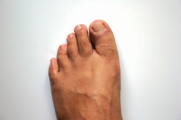 Figure out the nail, Accident nail trauma, bleeding toe nails, Foot ulcers figure out a nail,...