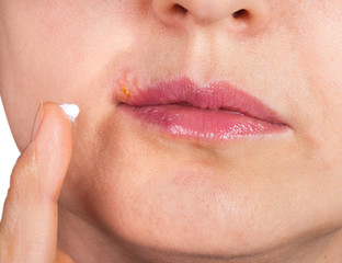 Herpes on the lip close-up macro. Woman lubricates the labial herpes ointment