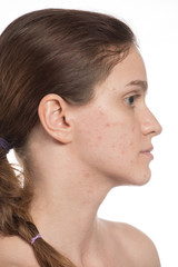 Beautiful young girl with red and white acne on her face. Before and after cream with sponge on a white background.