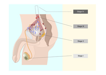 One of the many types of testicular cancer and its spreading
