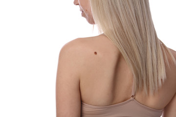 Young woman with birthmarks on her back and face isolated on white background. Dermatology, Checking benign moles. Skin tags removal concept