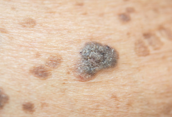 freckles on the skin