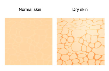 Dry skin and normal skin.