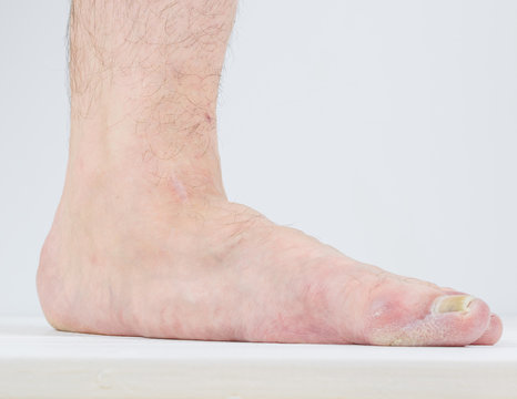 Manifestation of flat feet and fungal diseases.