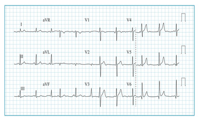 Heart Cardiogram Chart Vector. Illustration Of Wave Form On Checked Ecg Graph. Heart Rhythm, Ischemia, Infarction. Vitality Heartbeat