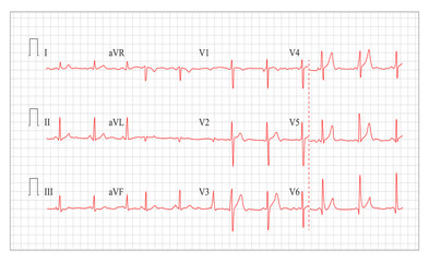 Heart Cardiogram Chart Vector. Set Healthy Heart Rhythm, Ischemia, Infarction. Vitality Heartbeat, Heart Electrocardiogram, Pulse Line