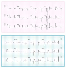 Heart Cardiogram Chart Vector. Set Healthy Heart Rhythm, Ischemia, Infarction. Vitality Heartbeat, Heart Electrocardiogram, Pulse Line