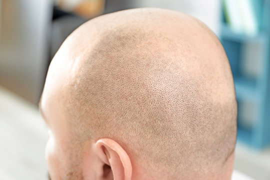 Bald man on blurred background, closeup