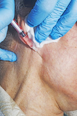 Dermatologist cosmetologist applies cosmetic injection of botox on a middle-aged patient at beauty clinic