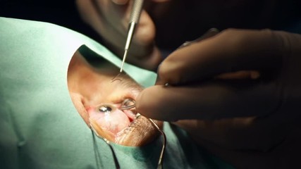 anesthesia before laser surgery vision correction, ophthalmology operation, Surgeon's hands in gloves performing laser eye vision correction correction, surgery eye, Cataract surgery