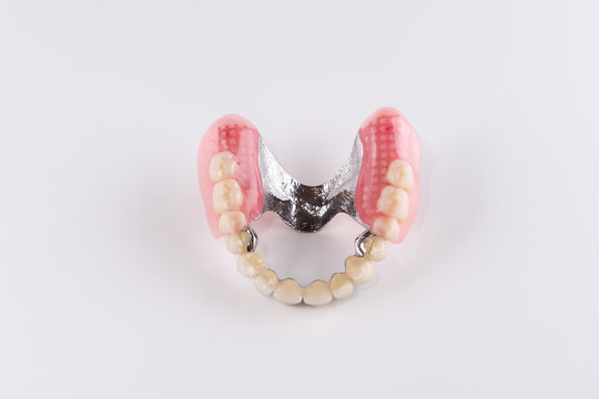 Clasp prosthesis with attachments fixing ceramic crowns