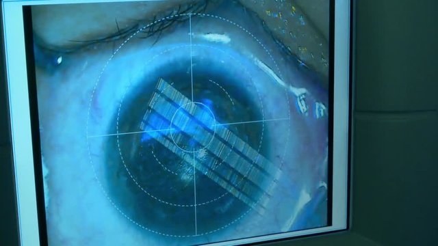 The operation on the eye. Cataract surgery
