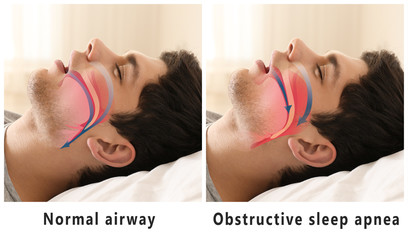 Snore problem concept. Illustration of normal airway and obstructive sleep apnea - obrazy, fototapety, plakaty
