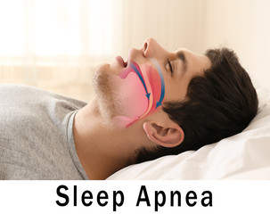 Snore problem concept. Illustration of obstructive sleep apnea - obrazy, fototapety, plakaty