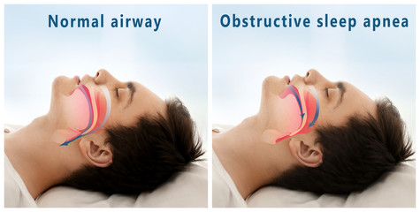 Snore problem concept. Illustration of normal airway and obstructive sleep apnea - obrazy, fototapety, plakaty