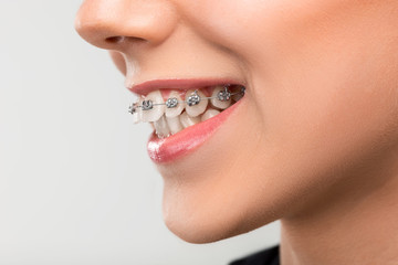 Obraz premium Piękna młoda kobieta z szelkami zębów
