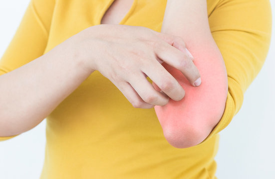 Women scratch the itch on elbow surface, Healthcare concept.