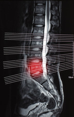 Magnetic resonance imaging of human show fracture and compress spine.