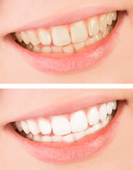 Whiten - smile and teeth whitening treatment before and after.