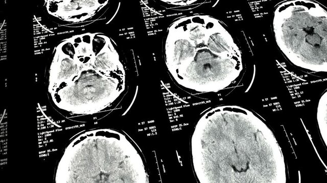Magnetic Resonance Tomography of Humain Brain