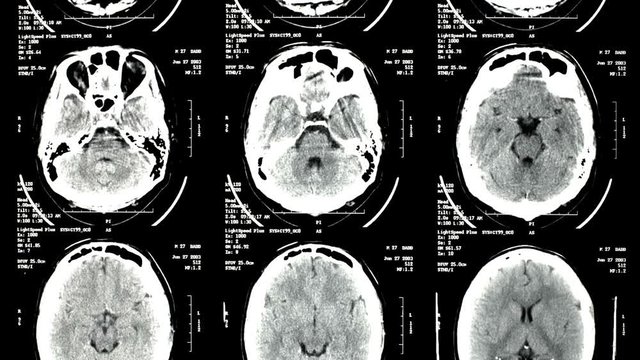 MRT_Magnetic Resonance Tomography of Humain Brain