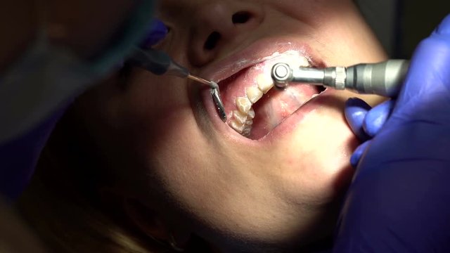 Young woman in dentist chair, close-up. Dentist carefully examines or cleans teeth of a woman