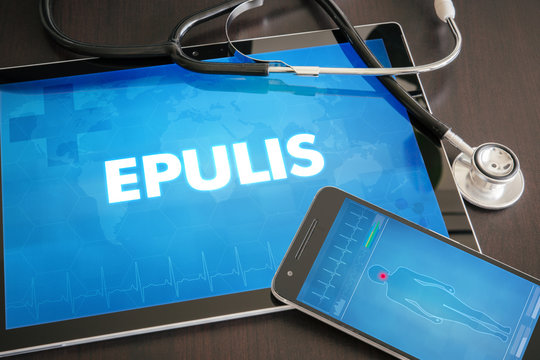 Epulis (cutaneous disease) diagnosis medical concept on tablet screen with stethoscope