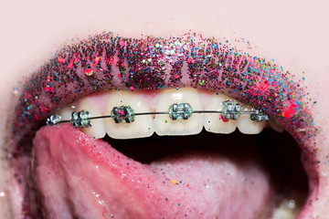 Dental braces on female teeth and luxury fashionable lipstick with shine and lip gloss close up. Sensual sexy tongue on teeth with braces. Dentistry for fashionable and beautiful girls. Healthy smile