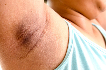 Black armpit, pregnancy women effect