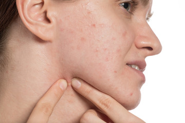 Beautiful young girl with red and white acne on her face. Before and after cream with sponge on a white background.