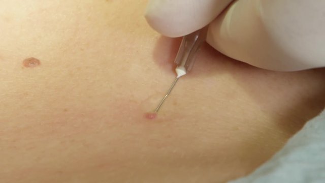 EXTREME CLOSE UP, MACRO: Dermatologist injecting local anesthetic to unrecognizable female patient before birthmark removal. Aesthetic surgery procedure of removing benign beauty mark on human body