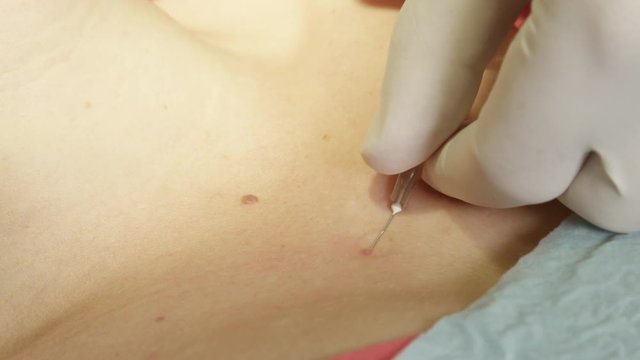 Extreme close up skin specialist giving a shot of local anesthetic to unrecognizable female patient before birthmark removal