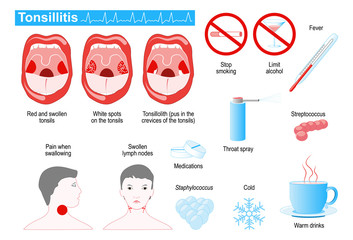 tonsillitis infographic