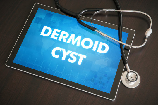 Dermoid cyst (cutaneous disease) diagnosis medical concept on tablet screen with stethoscope