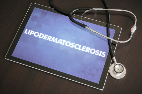 Lipodermatosclerosis (cutaneous disease) diagnosis medical concept on tablet screen with stethoscope