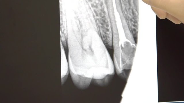 Close up shot of tooth roentgen. Dentist shows his patient his dental problems.