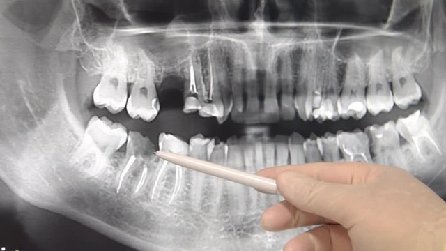 Close up shot of dental doctor showing a handle on roentgen of the teeth of man.