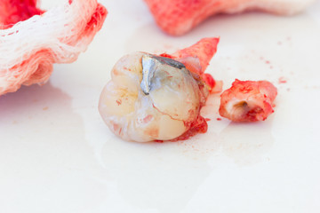 Extraction of decayed tooth with bloody gauze pad on white background. health concept.